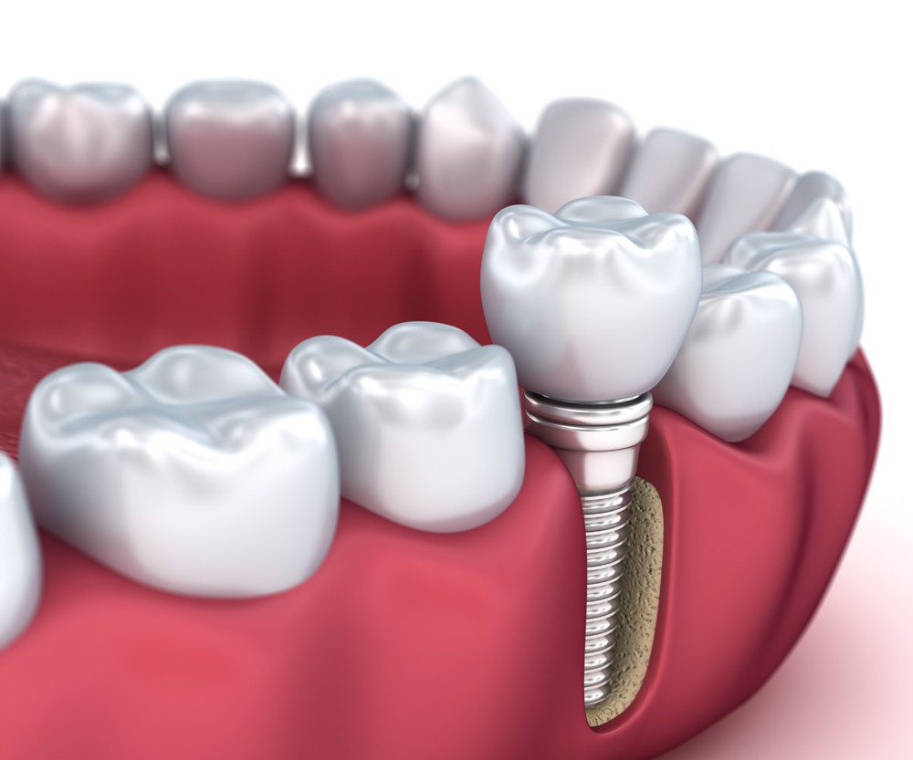 How Dental Implants Function