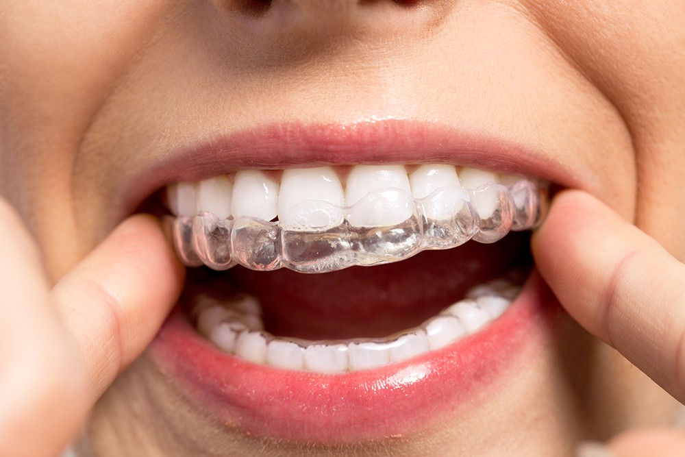 Why Isn't Invisalign Right for Everyone