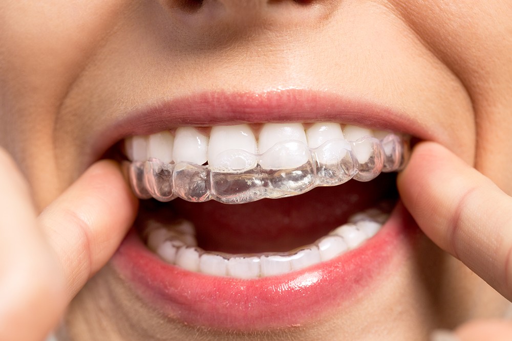 Clear Braces Vs. Clear Aligners: What Is the Difference?