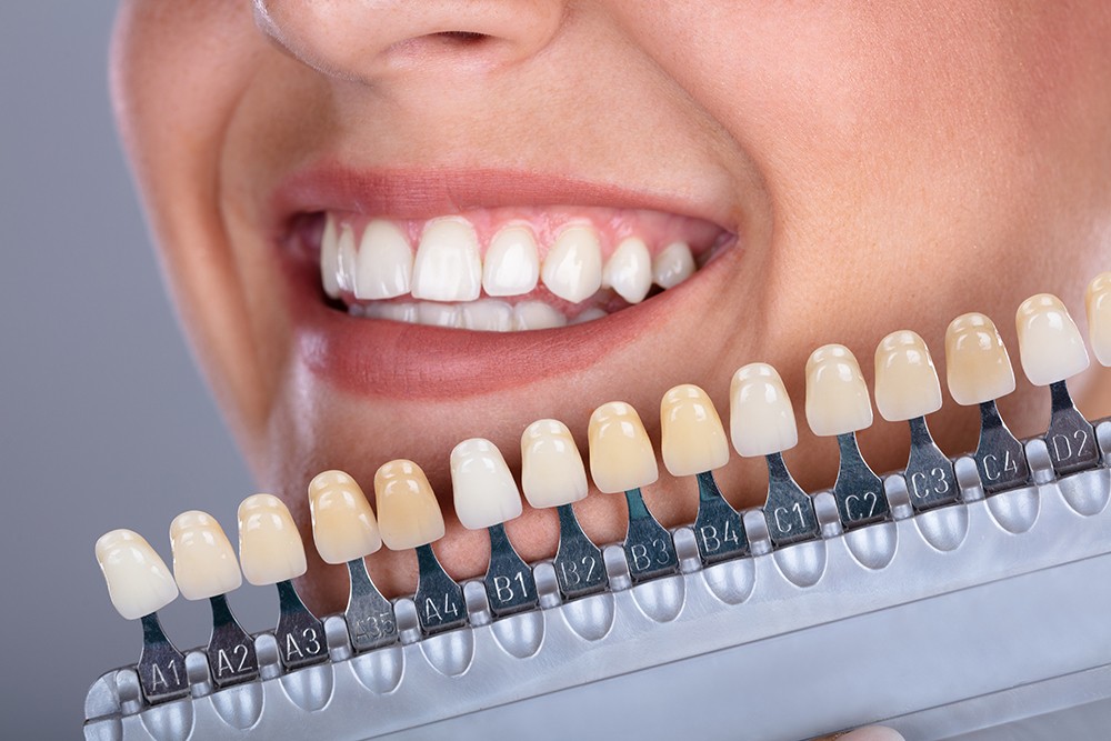 Dental Veneers Vs Dental Bonding: Which to Choose
