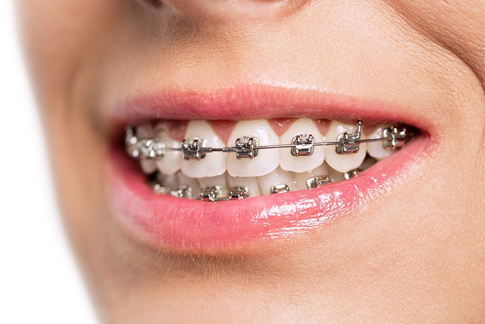 Clear Braces Vs. Clear Aligners: What Is the Difference?