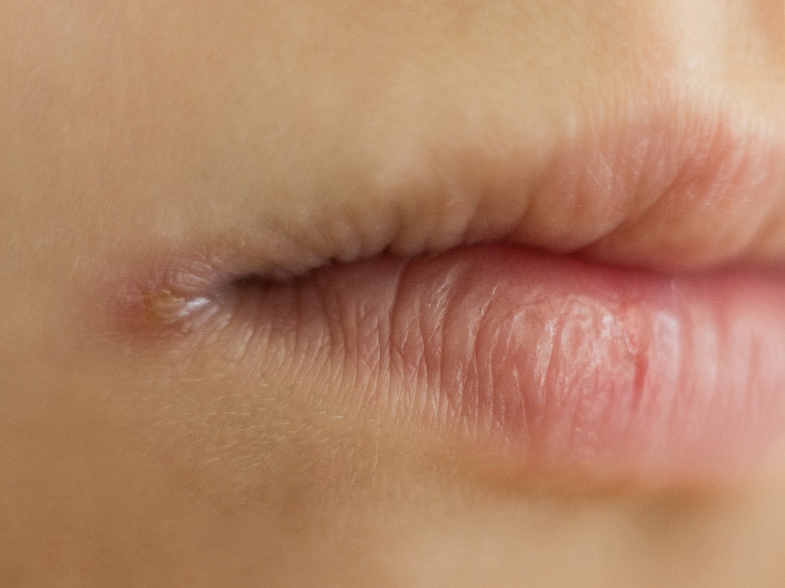 how-to-get-rid-of-dry-chapped-lips