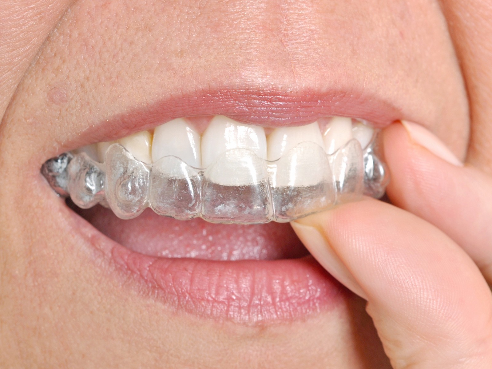 When does Invisalign move the most?