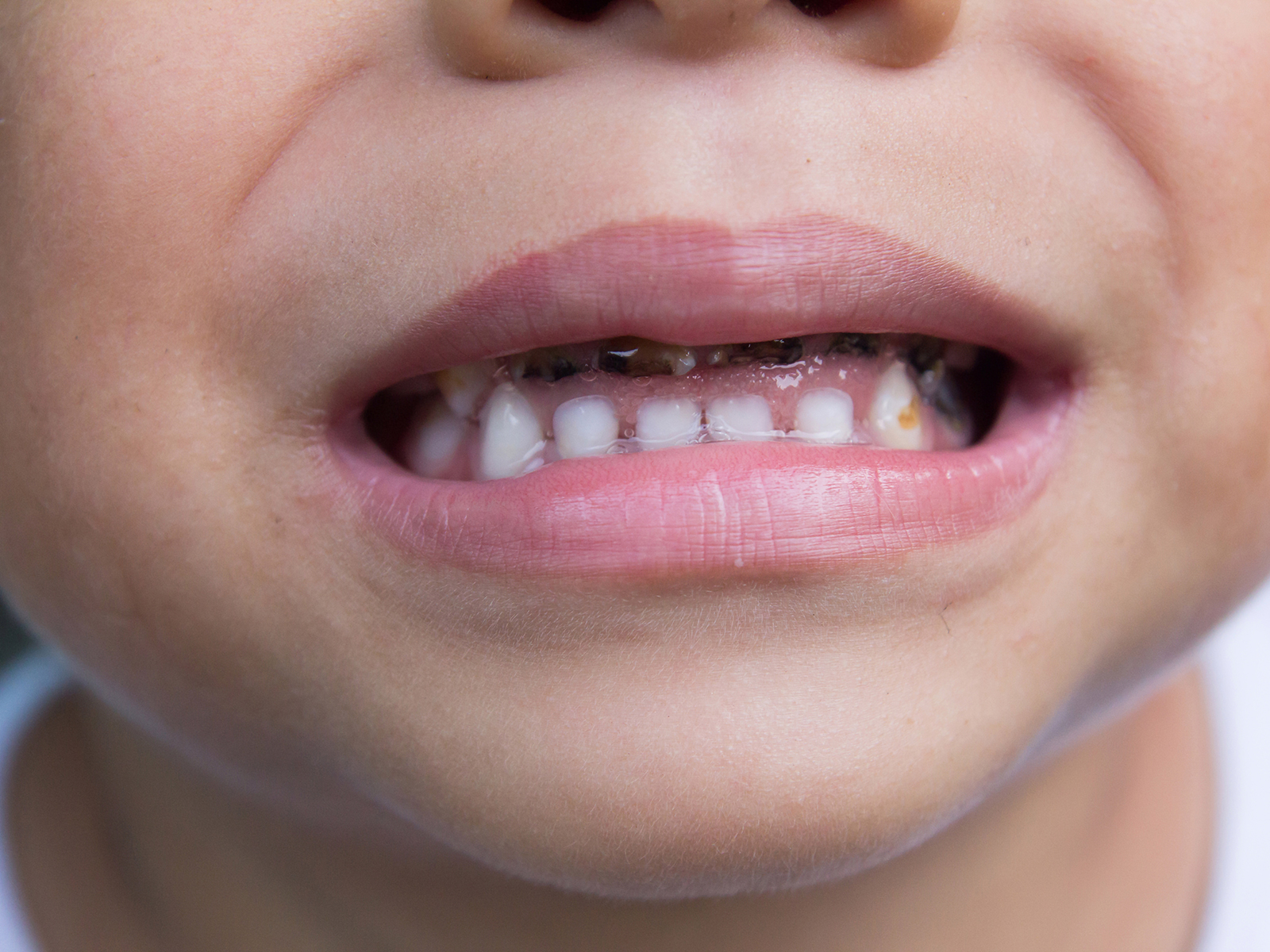 Do genetics play a role in tooth decay?