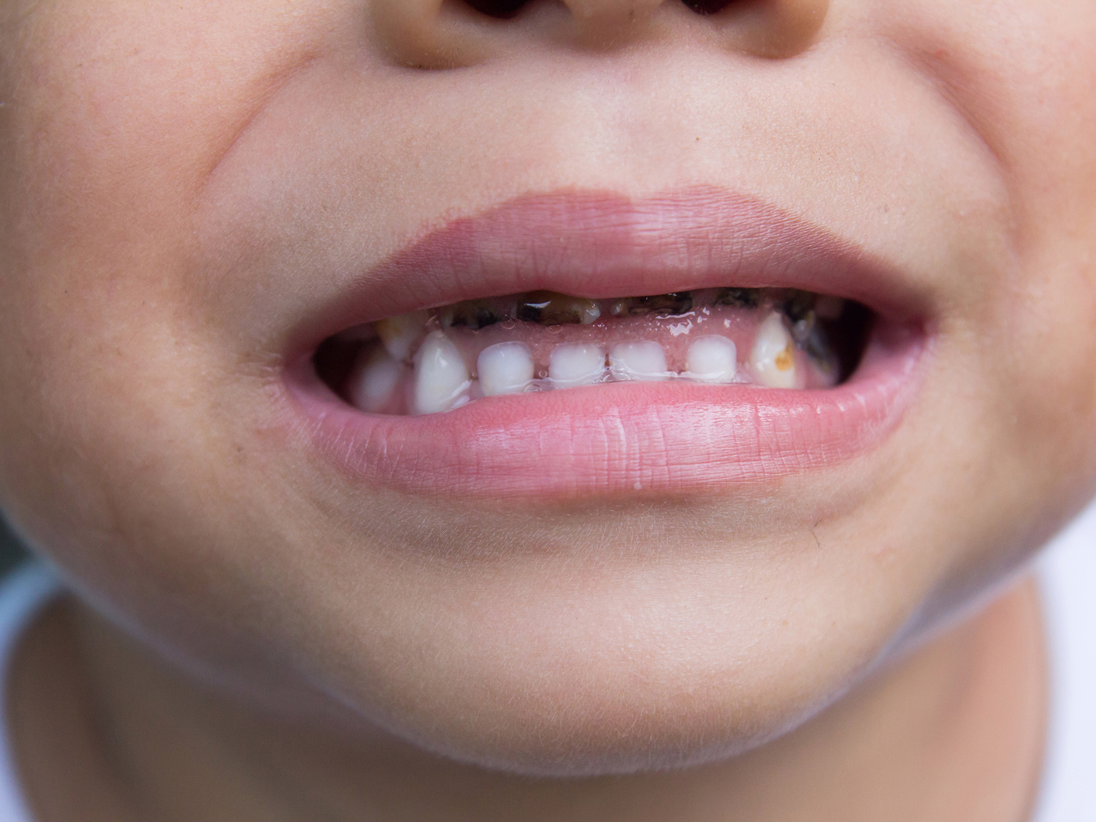 Do Genetics Play A Role In Tooth Decay 