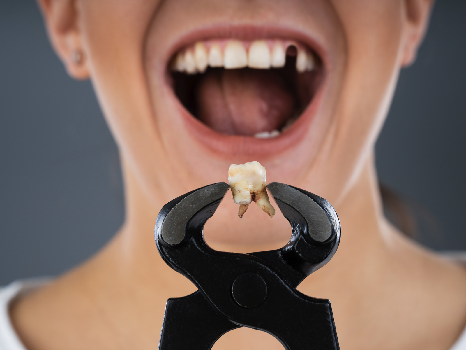 5 Dental Procedures To Repair Your Cracked or Broken Tooth