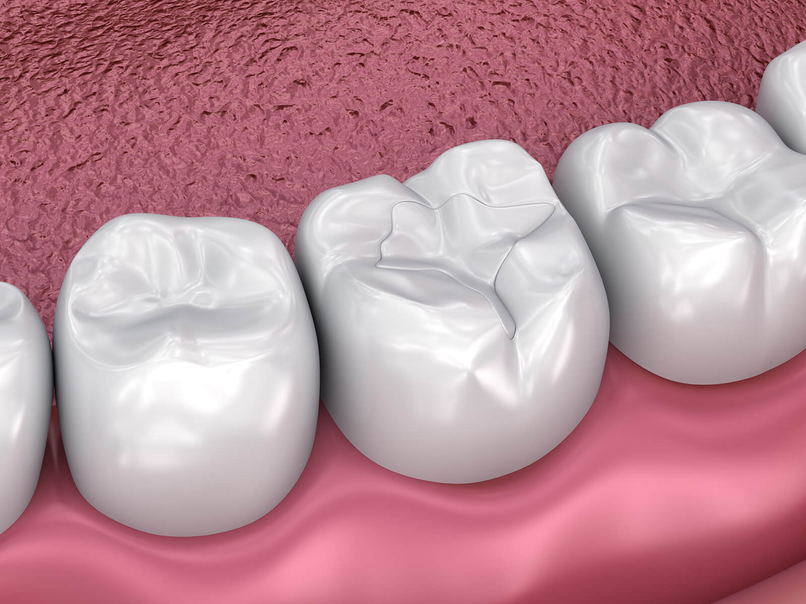 The Cost of Dental Sealants: Is It Worth The Investment?