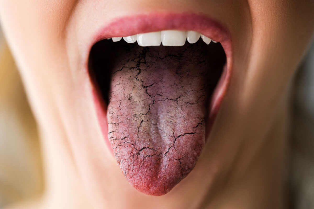 Diet-And-Nutrition-Tips-For-Healing-Cracked-Mouth-Corners