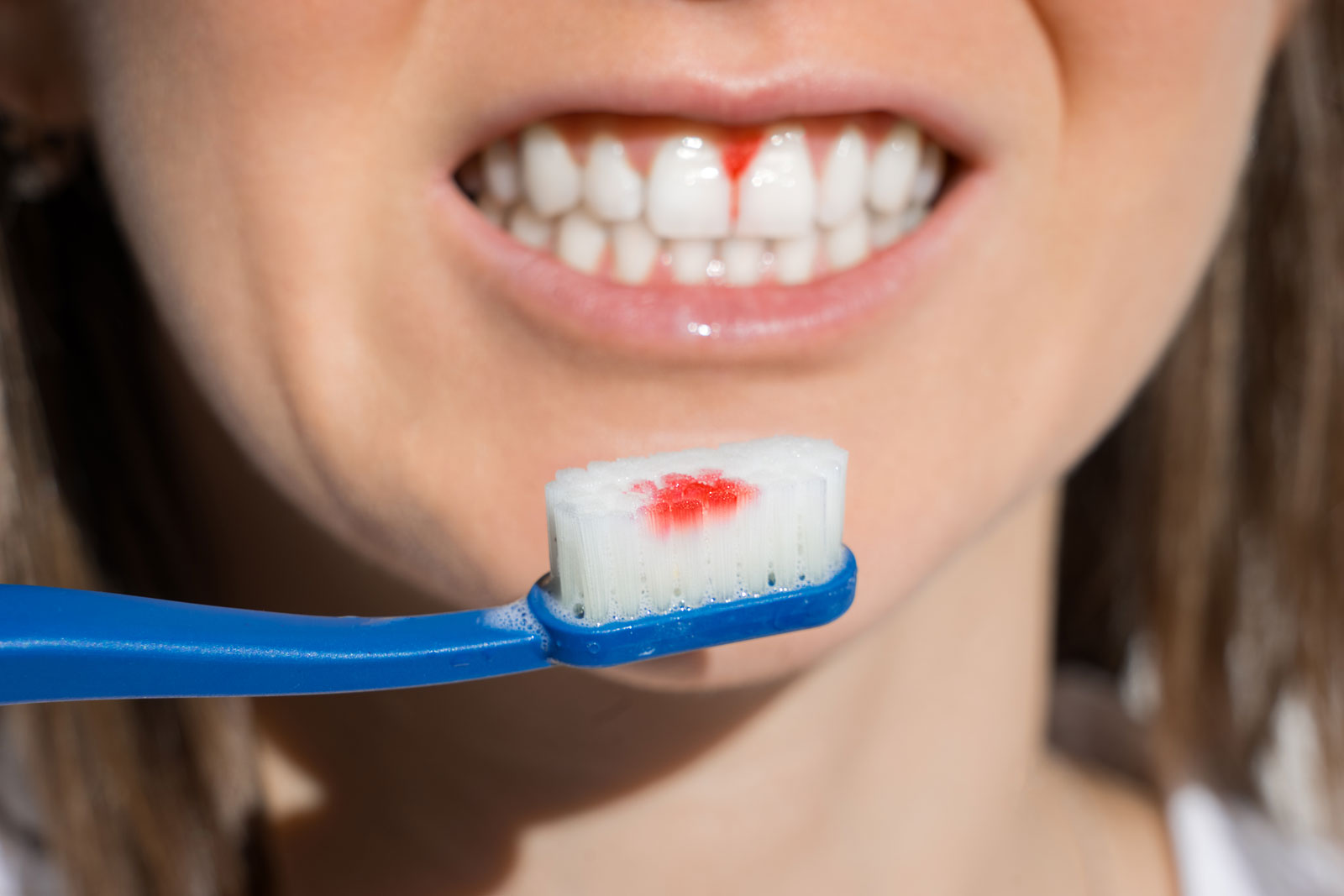 Bleeding Gums When Flossing: Should You Call Your Dentist?