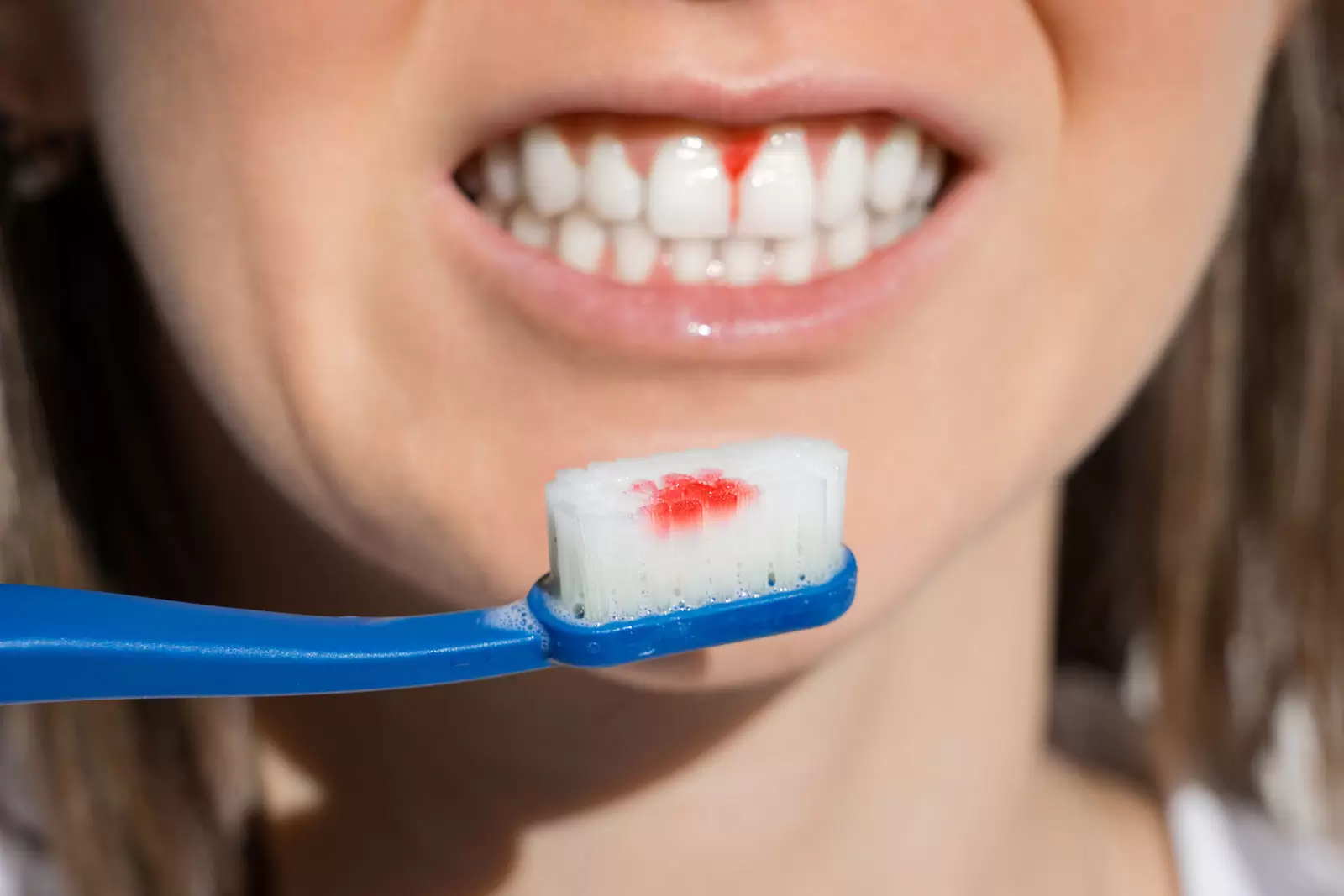 Bleeding Gums When Flossing: Should You Call Your Dentist?