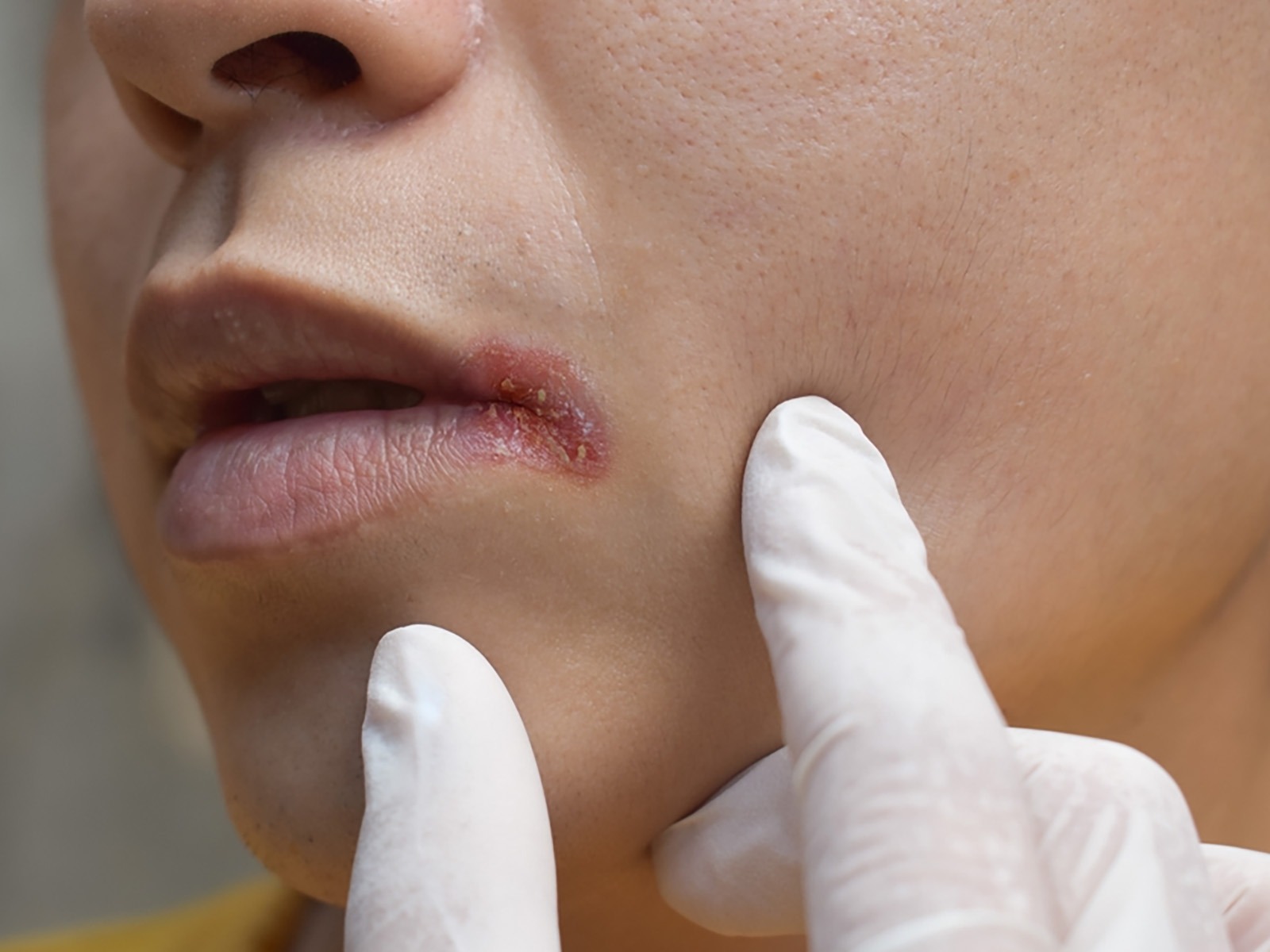 How To Prevent And Treat Angular Cheilitis