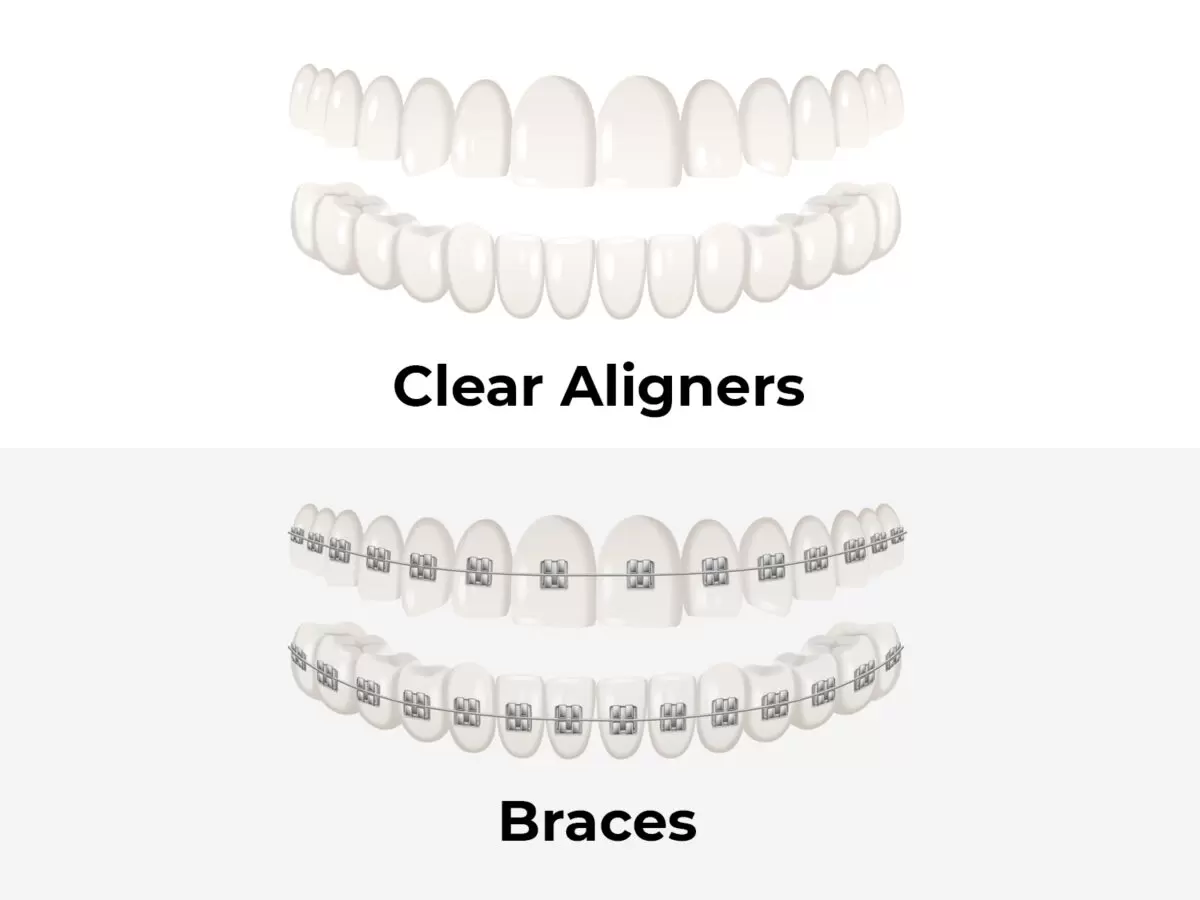 Clear Braces Vs. Clear Aligners