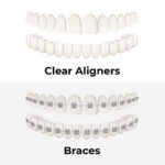 Clear Braces Vs. Clear Aligners