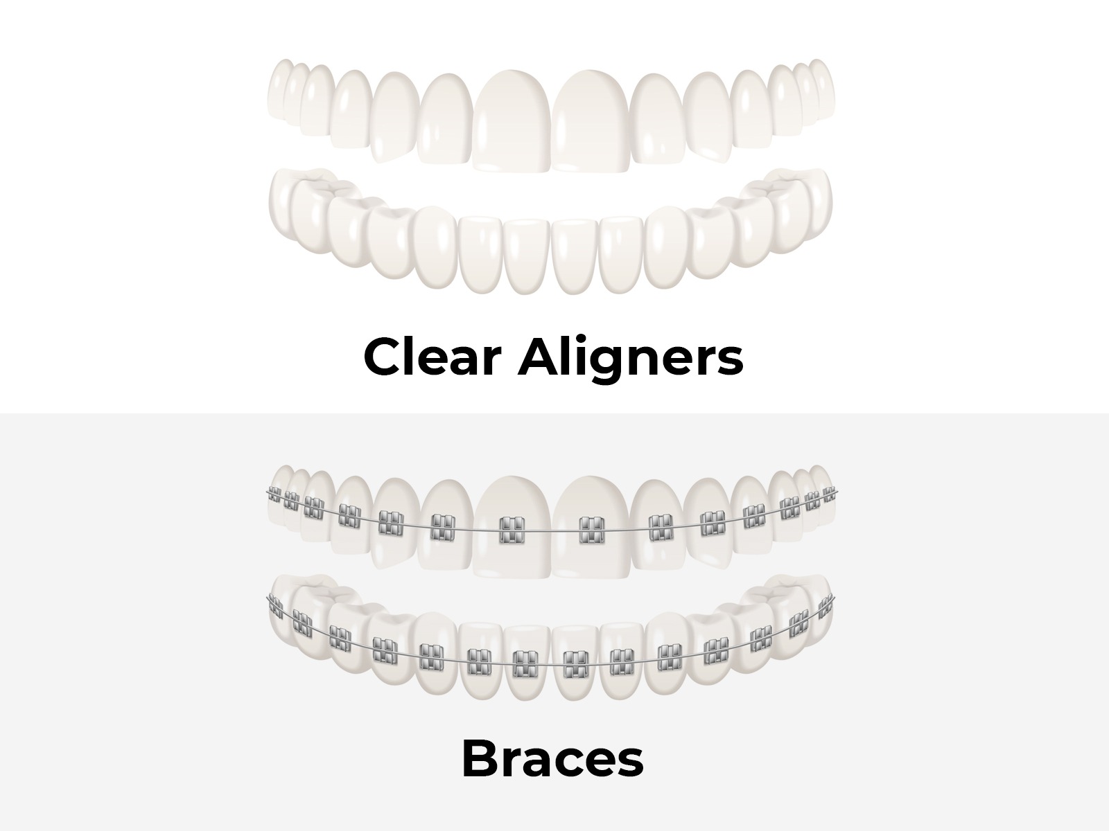 Clear Braces Vs. Clear Aligners: What Is The Difference?