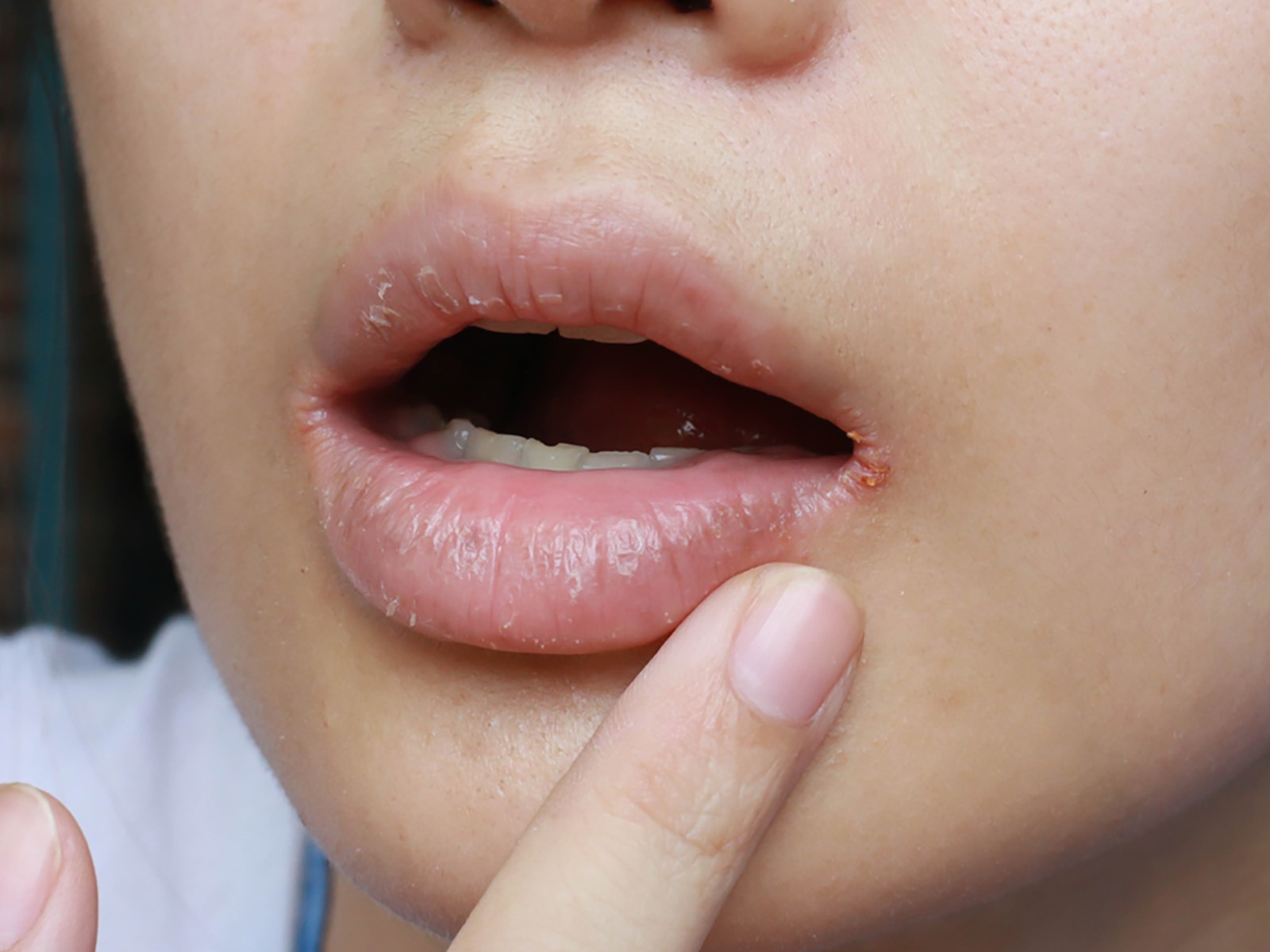 Common Reasons Your Lip Corners Are Cracking