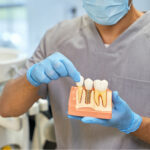 How Many Teeth Can Be Replaced With Dental Implants