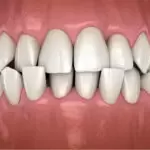 What Is A Crossbite And How Is It Corrected