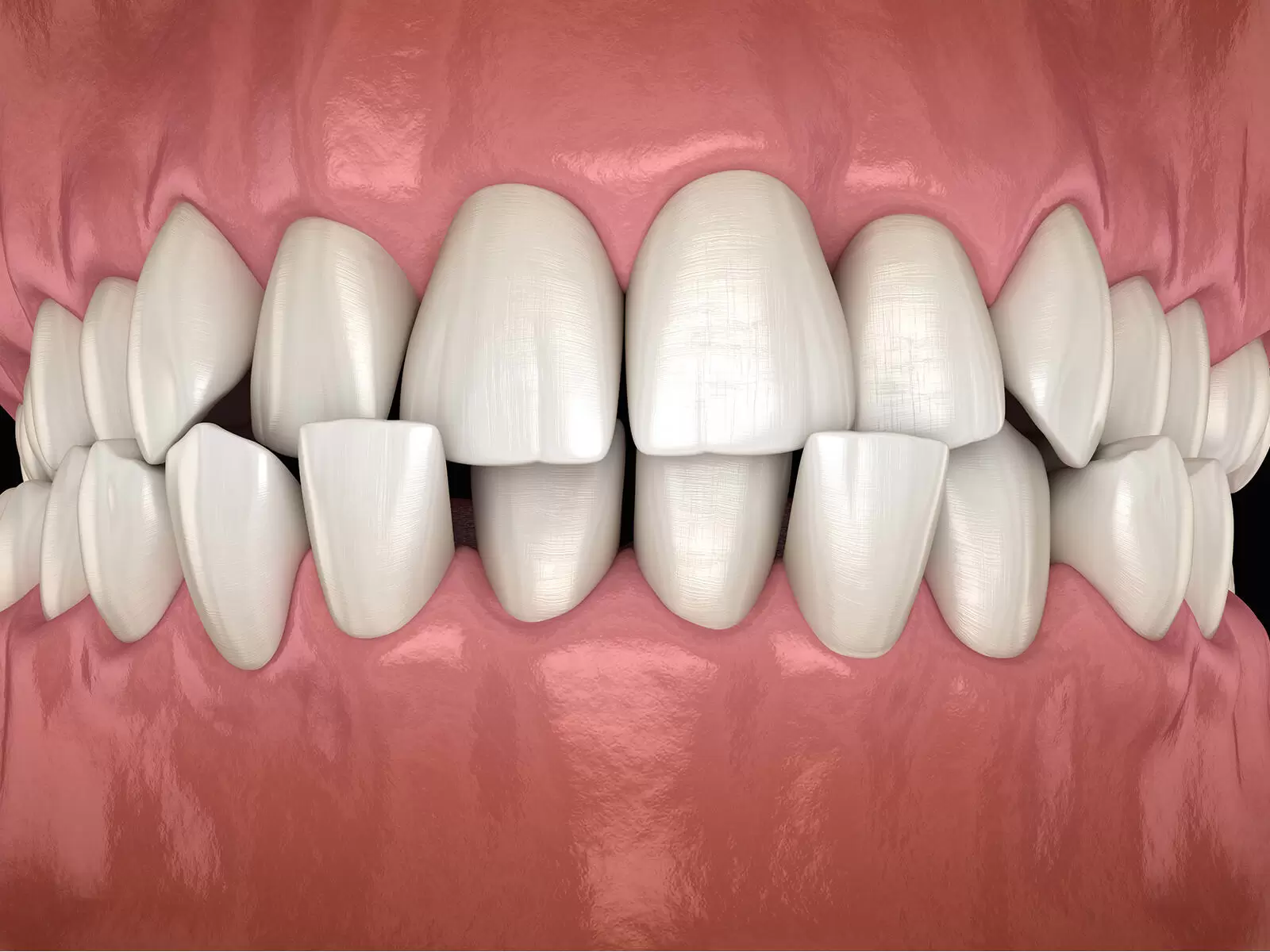 Understanding Crossbite: Causes, Effects, and Correction Methods