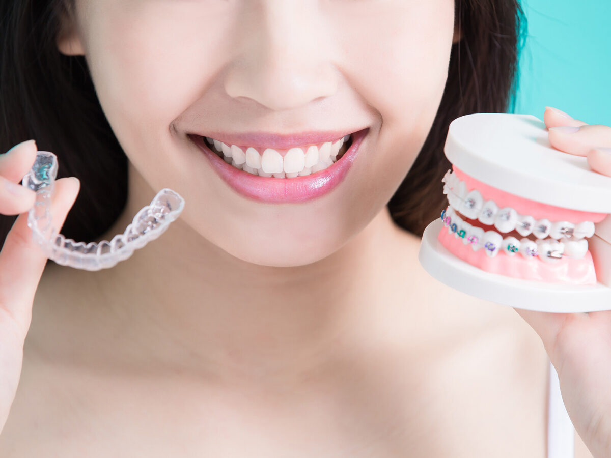 Traditional Braces Vs. Clear Aligners