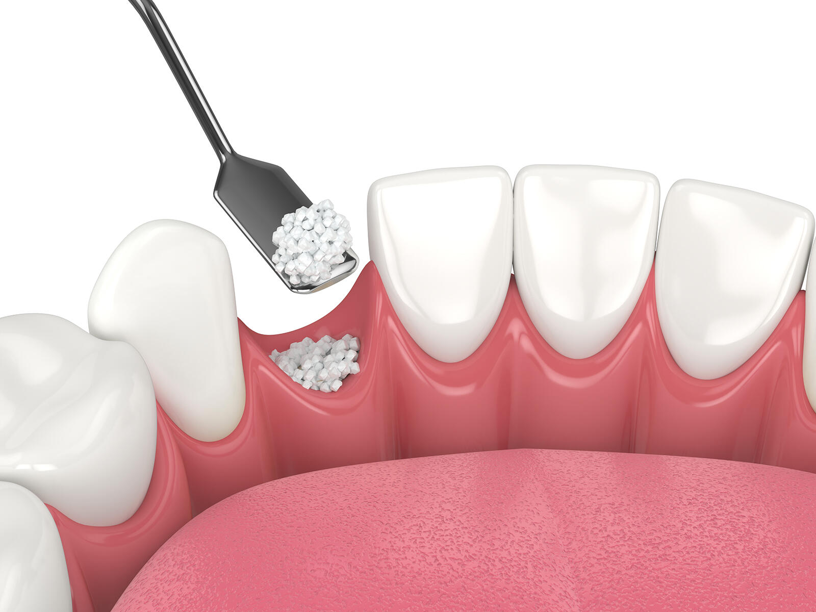 Understanding Bone Grafting In Oral Surgery