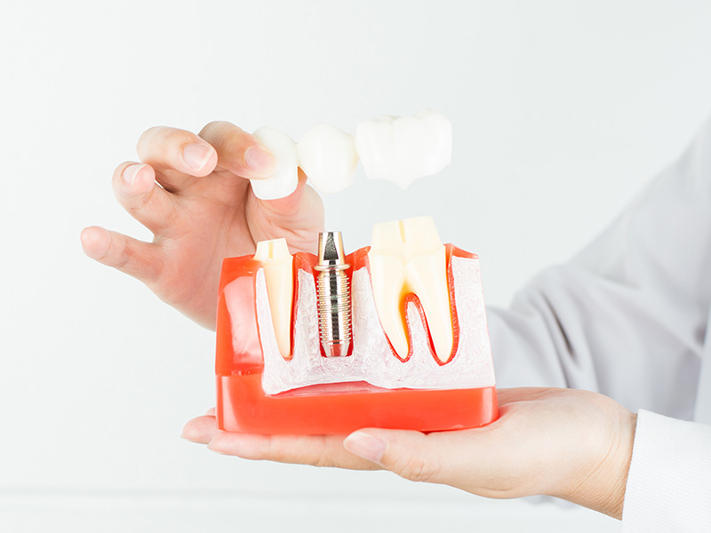 The Role of Implant Dentistry In Enhancing Quality of Life