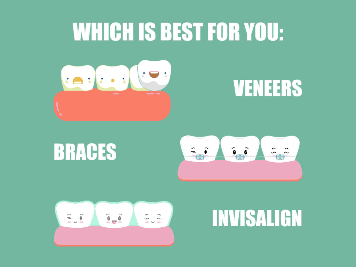 Which Is Best For You Veneers, Braces or Invisalign