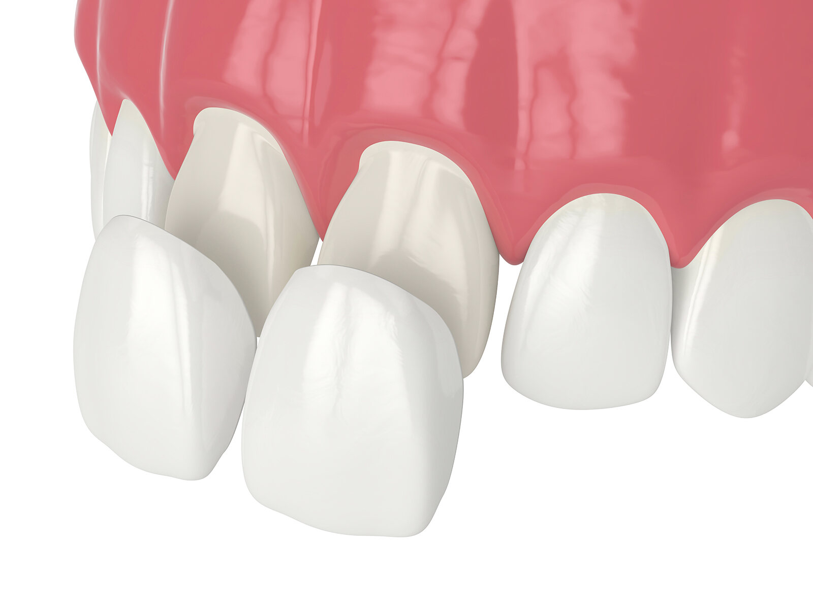 4 Common Dental Imperfections Veneers Can Fix