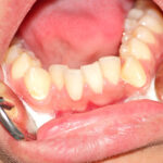 Cosmetic Dental Services To Fix Teeth Crowding