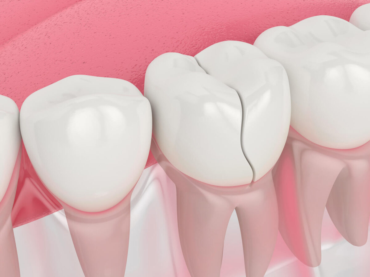 What To Do When You Have A Cracked Or Chipped Tooth