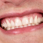 Understanding The Signs of White Gums And Its Health Implications