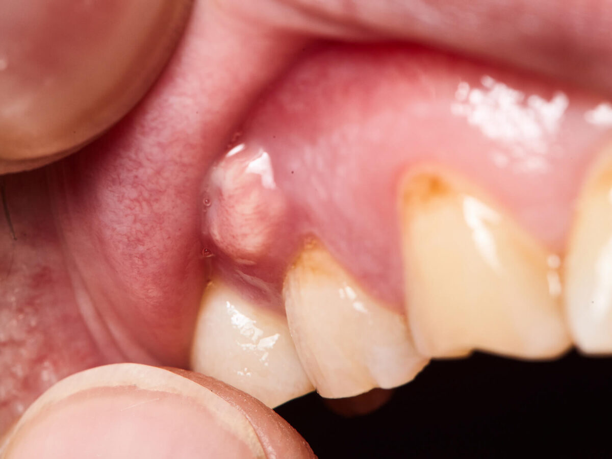 What Is A Tooth Abscess, And How Can You Prevent It?