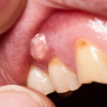 What Is A Tooth Abscess, And How Can You Prevent It?