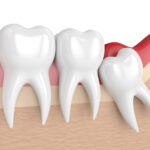 6 Wisdom Teeth Removal Recovery Tips