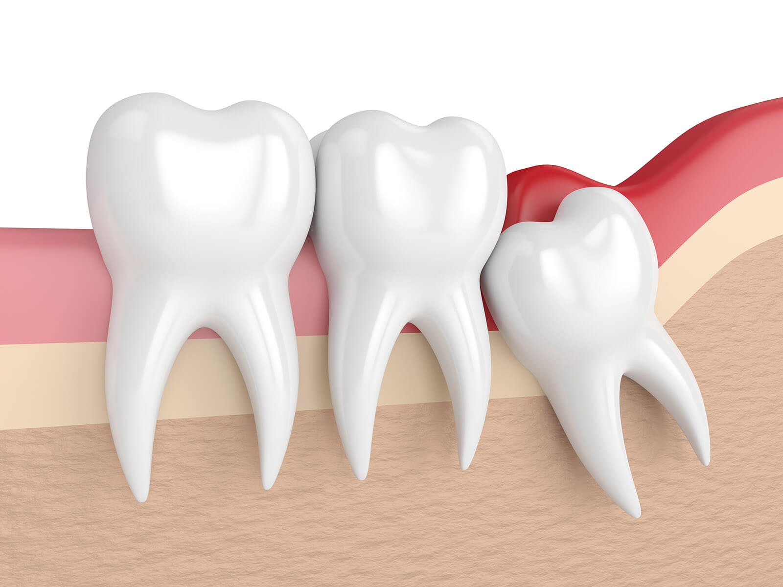 6 Wisdom Teeth Removal Recovery Tips