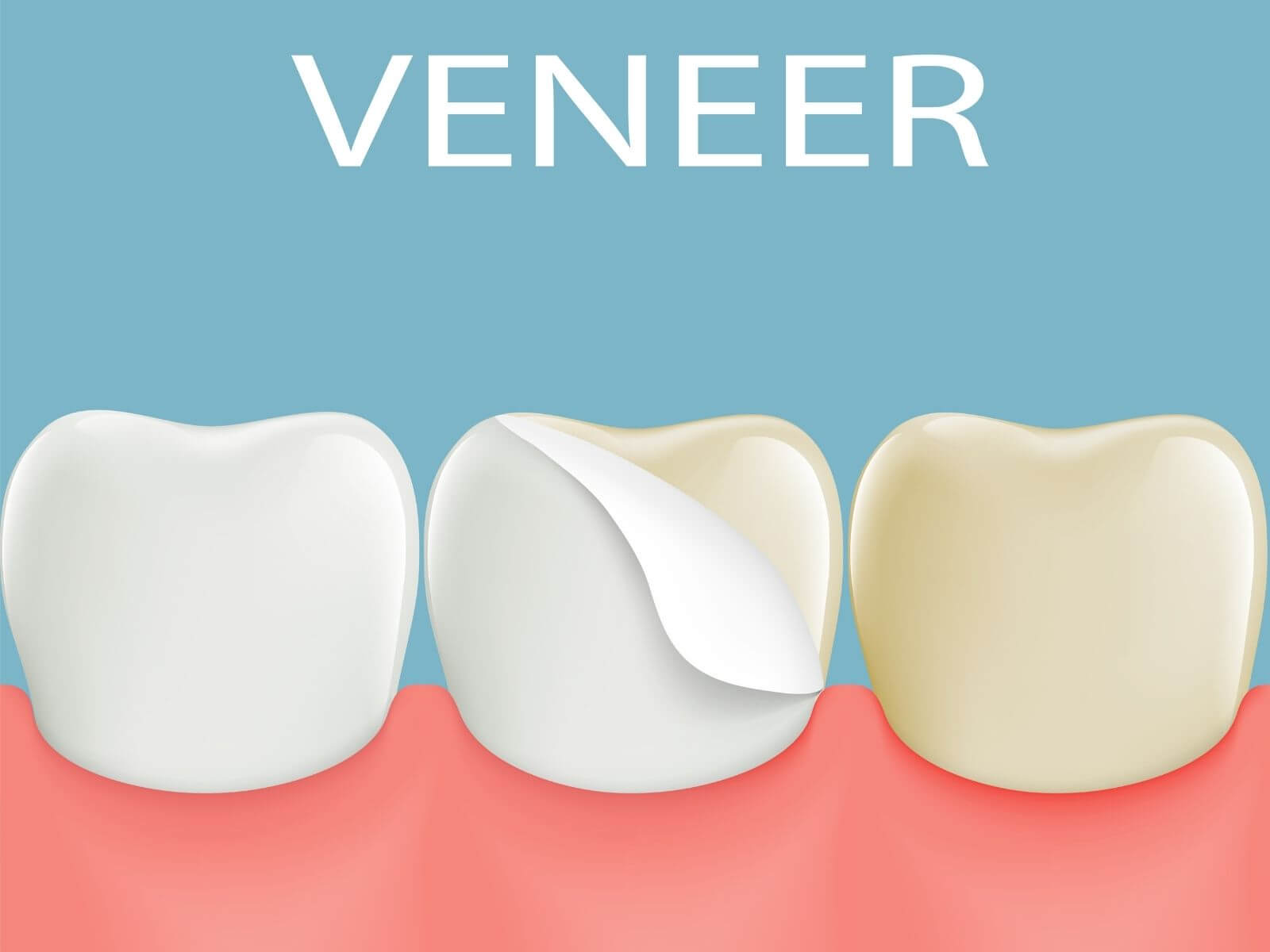 What Are The Pros And Cons of Veneers?