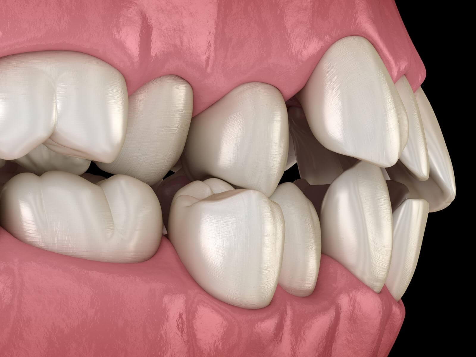 How Can Plaque Lead to Misaligned Teeth?
