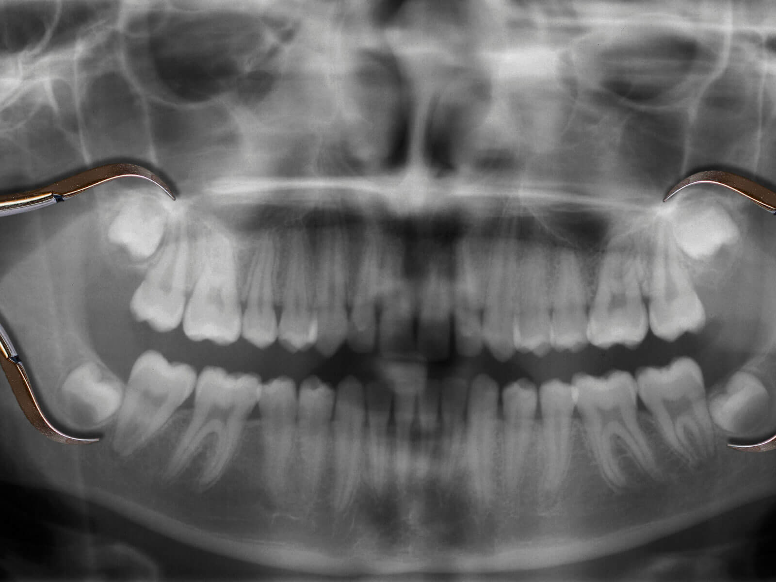5 Signs Your Wisdom Teeth Are Coming In