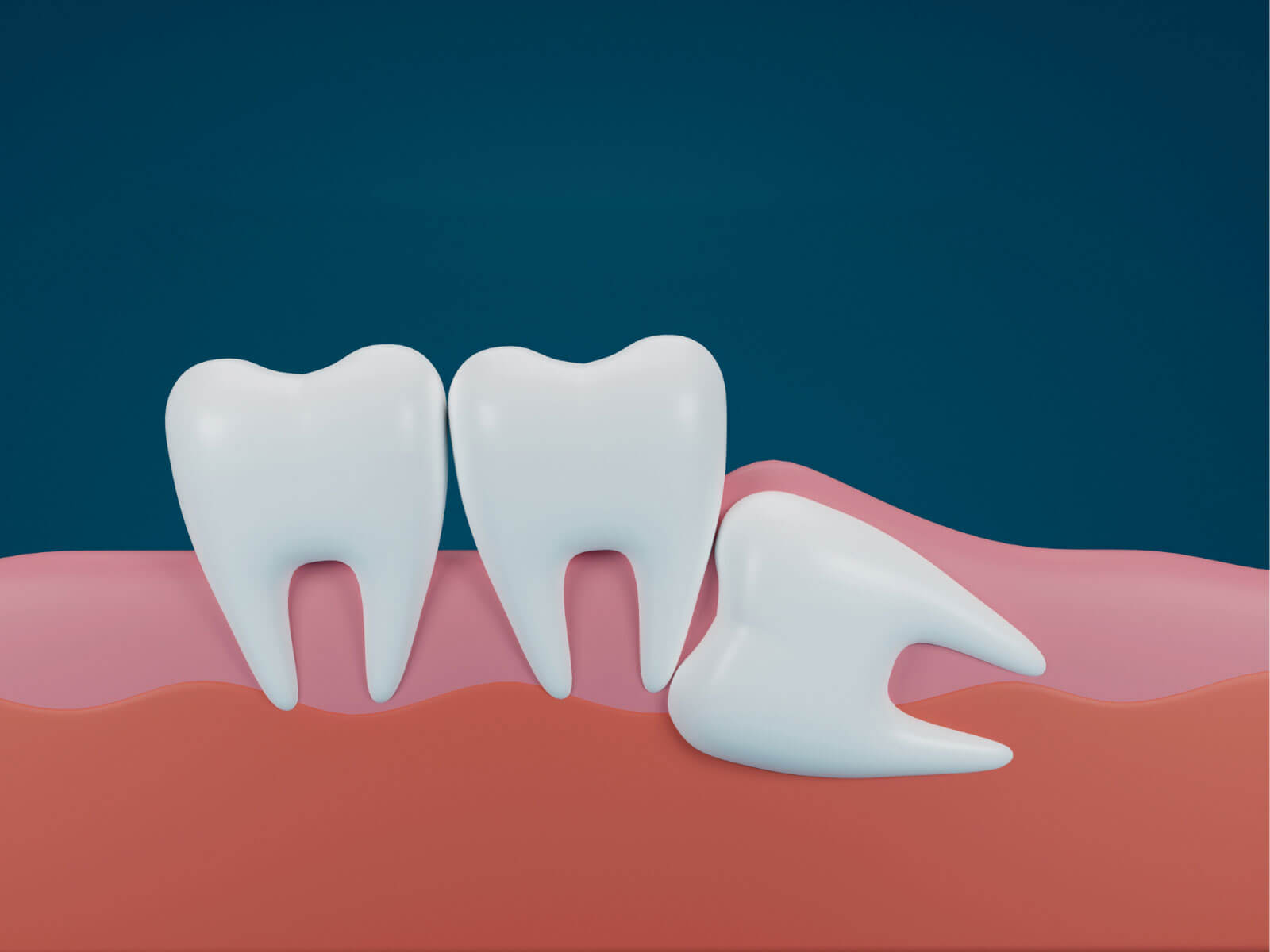 Does Everyone Have Wisdom Teeth?