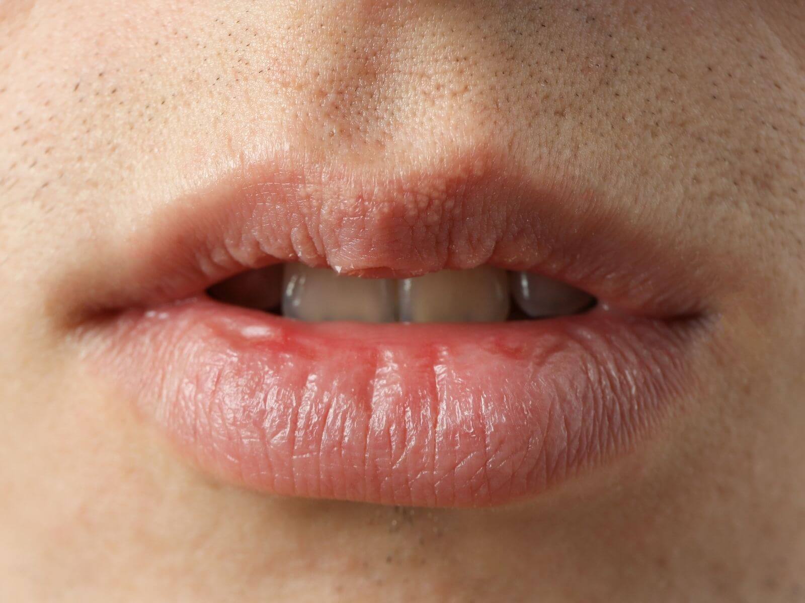 Dry Mouth: Why It Happens and How to Treat It