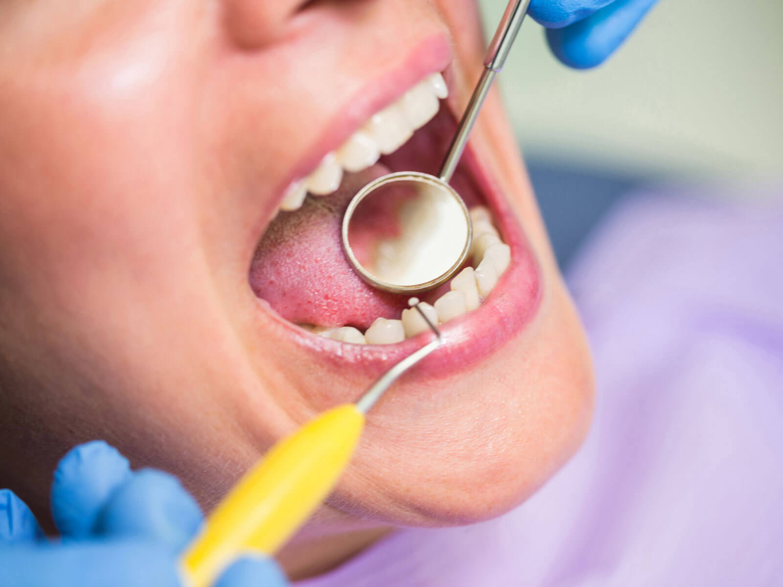 Dental Sealants Pros and Cons: Are They Worth It? Costs and Risks