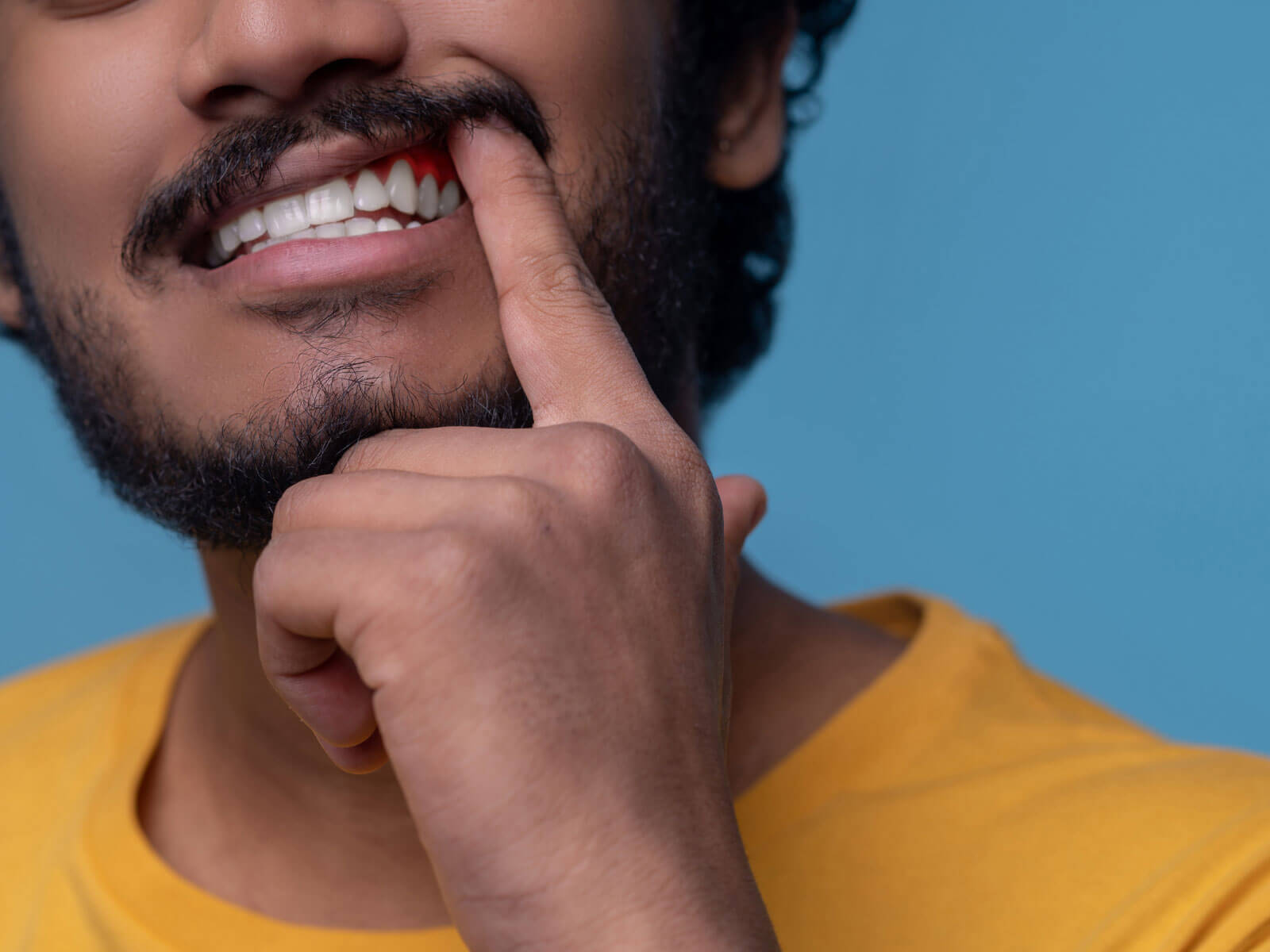 Gingival Hyperplasia: Causes, Symptoms, and Treatment Options (Including Drug-Induced Cases)
